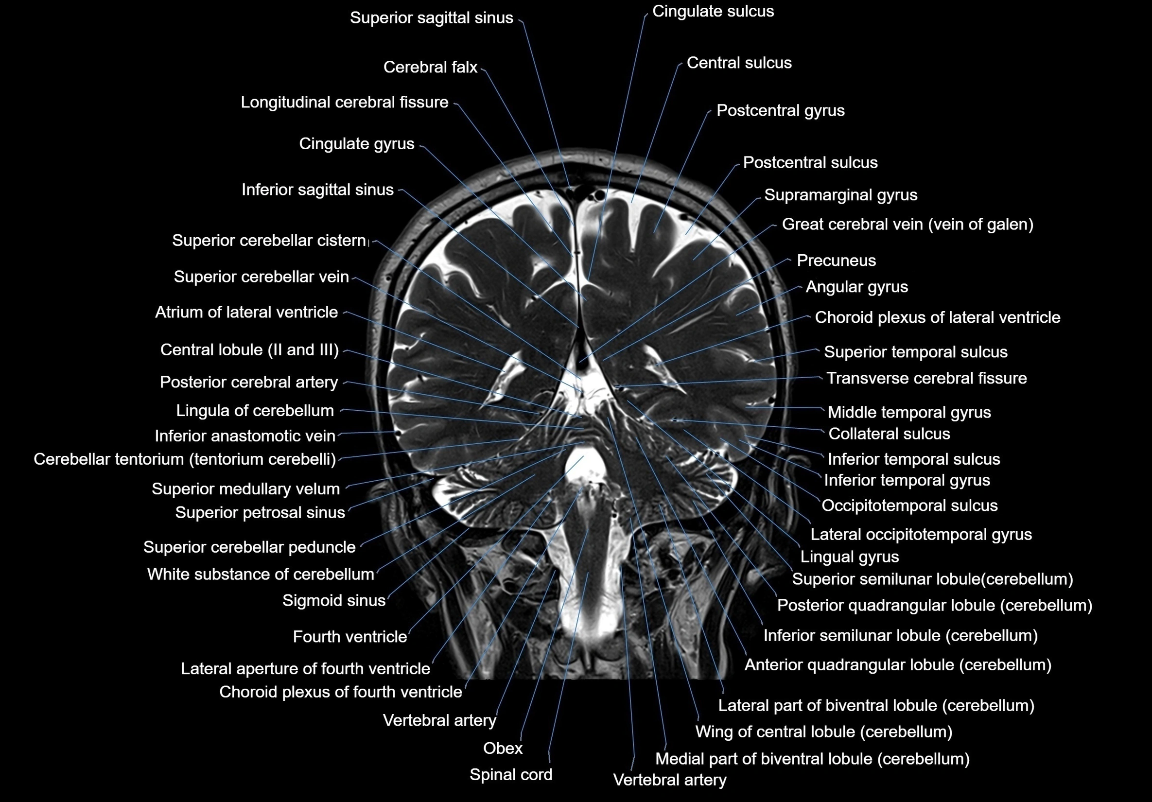 MRI Brain coronal cross sectional labelled anatomy 3T image  -img-00001-00050.webp